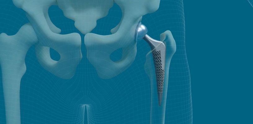 Additiv hergestelltes medizinisches Implantat, solide Gitter-Hüftprothese, selektives Laserschmelzen